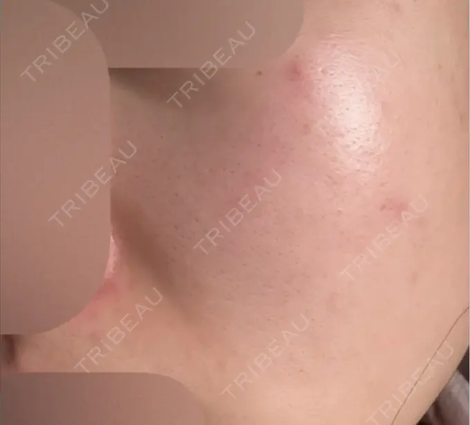 エレクトロポレーション / 毛穴洗浄（ハイドラフェイシャルなど） / 医療脱毛（顔） さっぽろ美容クリニック AFTER メイン用