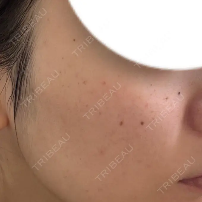 ピーリング（ニキビ・毛穴） / ルメッカ ルラ美容クリニック 大宮院 / ルラスキンクリニック 大宮院 DAY 2 メイン用