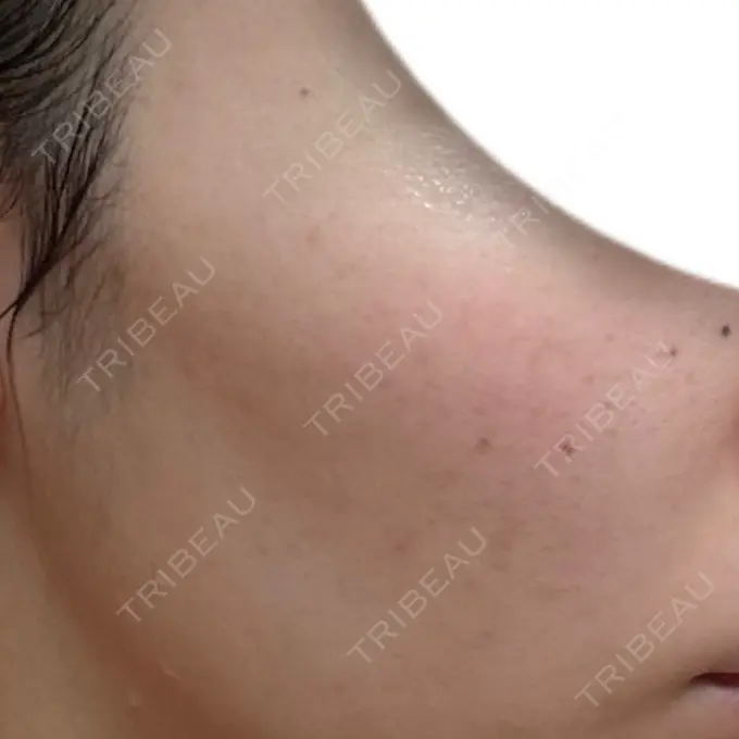 ピーリング（ニキビ・毛穴） / ルメッカ ルラ美容クリニック 大宮院 / ルラスキンクリニック 大宮院 DAY 5 メイン用