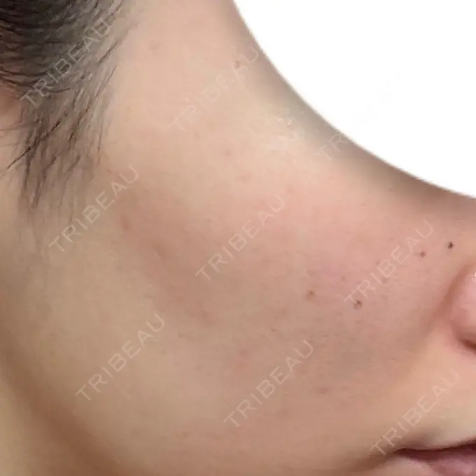 ピーリング（ニキビ・毛穴） / ルメッカ ルラ美容クリニック 大宮院 / ルラスキンクリニック 大宮院 AFTER メイン用