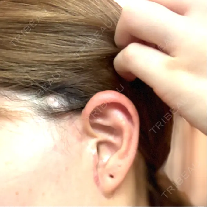 切開リフト GRACY TOKYO CLINIC【グレイシートウキョウクリニック】 DAY 42 メイン用