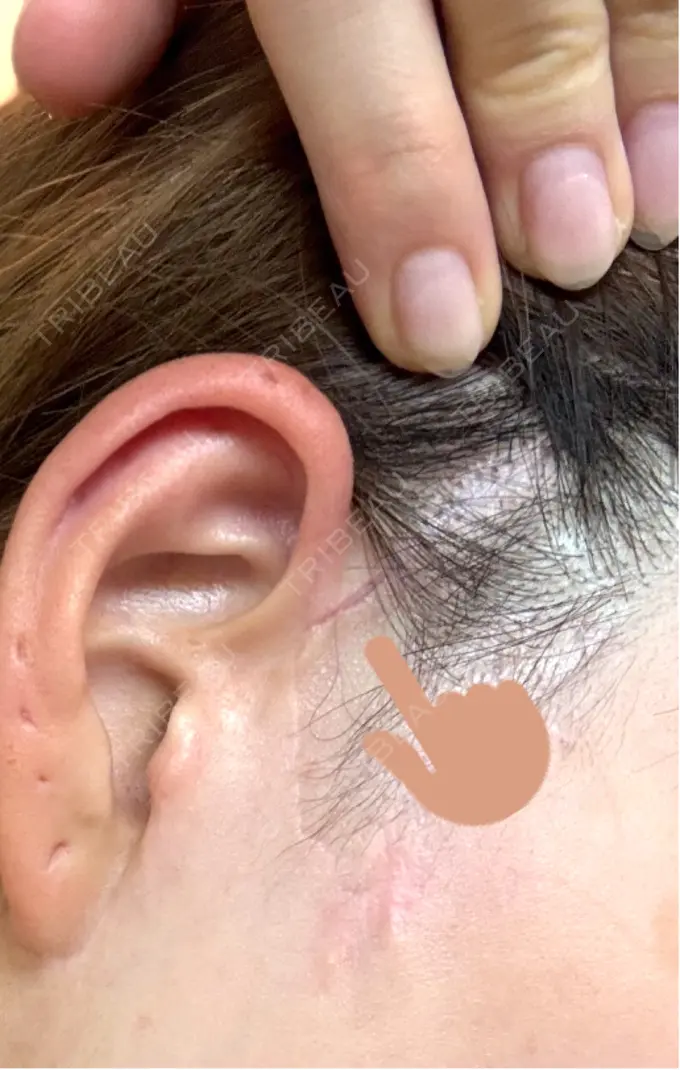 切開リフト GRACY TOKYO CLINIC【グレイシートウキョウクリニック】 DAY 42 メイン用