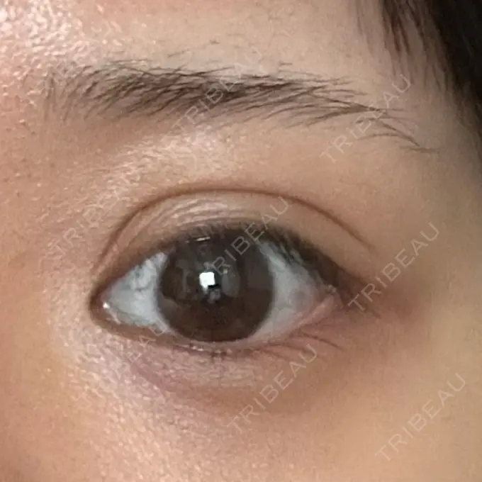 二重埋没 / ヒアルロン酸注入（涙袋） / ヒアルロン酸注入（唇） / その他（口元） 恵聖会クリニック 京橋院 DAY 3 メイン用