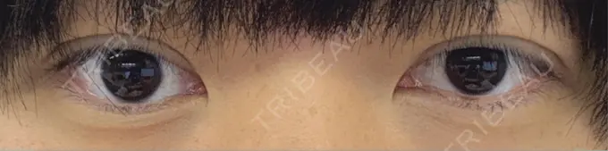 二重埋没 水の森美容クリニック 東京新宿院 DAY 3 メイン用