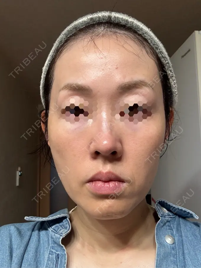 美容点滴・美容注射（美肌） / 白玉点滴・注射 / 美肌レーザー / シミ取りレーザー / 美白レーザー / ピコレーザートーニング（美白・肝斑） / レーザートーニング（美白・肝斑） LE CLINIC AFTER メイン用