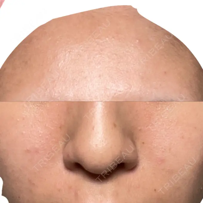 ピーリング（ニキビ・毛穴） EME CLINIC AFTER メイン用