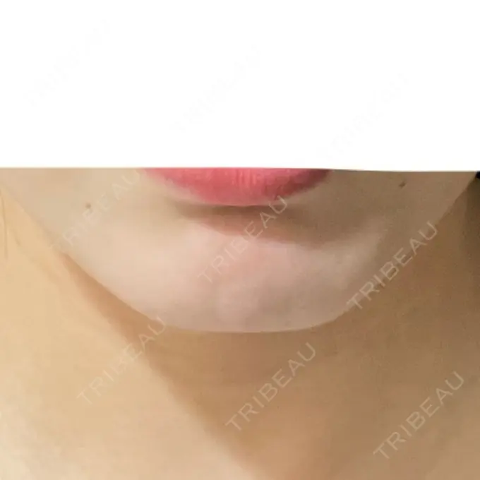 ボトックス（あご） / ヒアルロン酸注入（あご） HAAB×DREAM BEAUTY CLINIC 大阪梅田院 DAY 0 メイン用