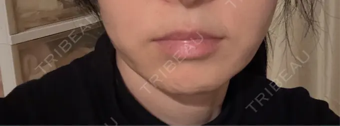 ヒアルロン酸注入（鼻翼基部） ルラ美容クリニック 渋谷本院 DAY 4 メイン用