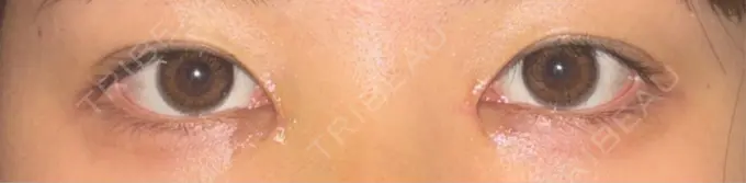 二重埋没 / 目頭切開 くさのたろうクリニック AFTER メイン用