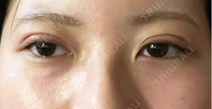 二重埋没 / 上まぶたの脂肪取り アリエル美容クリニック 横浜院 DAY 1 メイン用