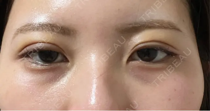 二重埋没 / 上まぶたの脂肪取り アリエル美容クリニック 横浜院 DAY 2 メイン用