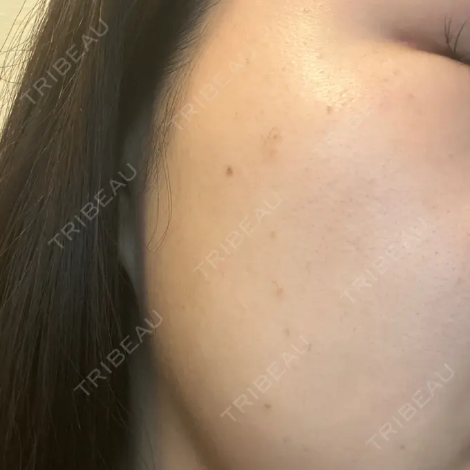 ピーリング（ハリ・ツヤ） / ルメッカ BITO BEAUTY CLINIC DAY 0 メイン用