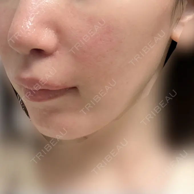 小鼻縮小（切開） / 人中短縮 / 鼻孔縁挙上 / 口角挙上 / ボトックス（口角） / ボトックス（人中） Otus Clinic 【オータスクリニック】 DAY 53 メイン用