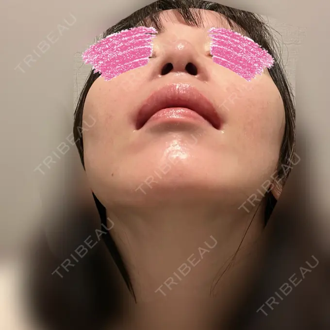 小鼻縮小（切開） / 人中短縮 / 鼻孔縁挙上 / 口角挙上 / ボトックス（口角） / ボトックス（人中） Otus Clinic 【オータスクリニック】 DAY 53 メイン用