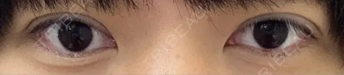 二重埋没 水の森美容クリニック 東京新宿院 DAY 4 メイン用