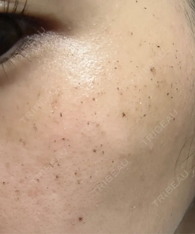 その他（肌） / イオン導入 / ルメッカ ルラ美容クリニック 広島院 DAY 4 メイン用