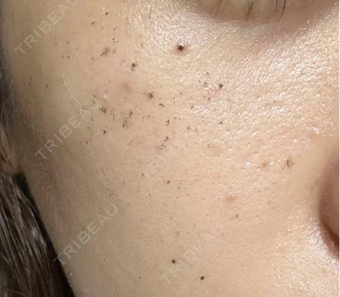 その他（肌） / イオン導入 / ルメッカ ルラ美容クリニック 広島院 DAY 4 メイン用