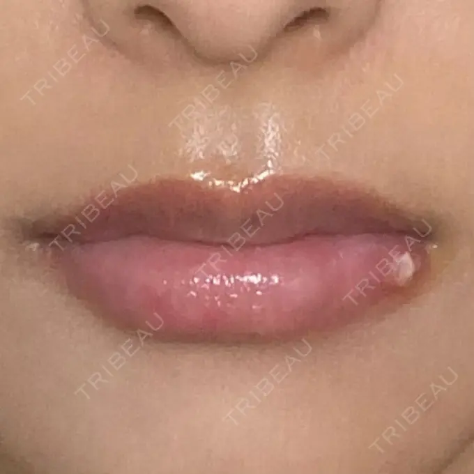 アートメイク（眉） / アートメイク（唇） Tokyo Tensei Clinic 新宿院 DAY 3 メイン用