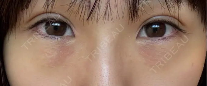 二重埋没 アリエル美容クリニック 横浜院 DAY 7 メイン用