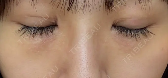 二重埋没 アリエル美容クリニック 横浜院 DAY 7 メイン用