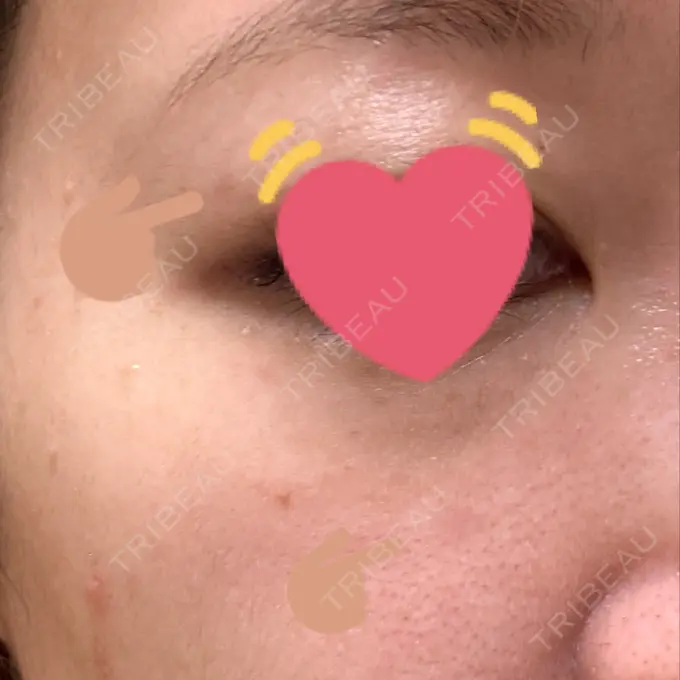 ほくろ・いぼ除去レーザー（肌） Mavie Beauty Clinic （マヴィービューティークリニック） DAY 180 メイン用