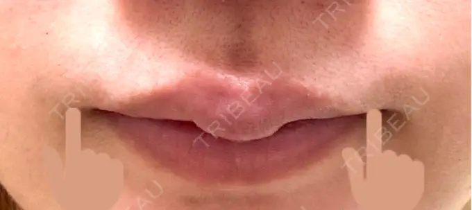 ほくろ・いぼ除去レーザー（肌） Mavie Beauty Clinic （マヴィービューティークリニック） DAY 180 メイン用