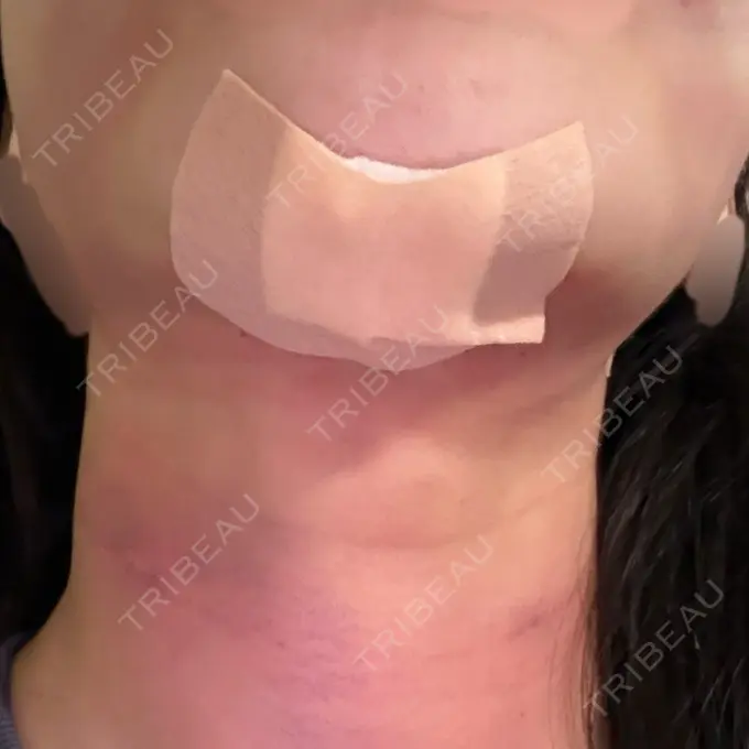 糸リフト / 脂肪吸引（顔） 東京ココセランクリニック DAY 1 メイン用