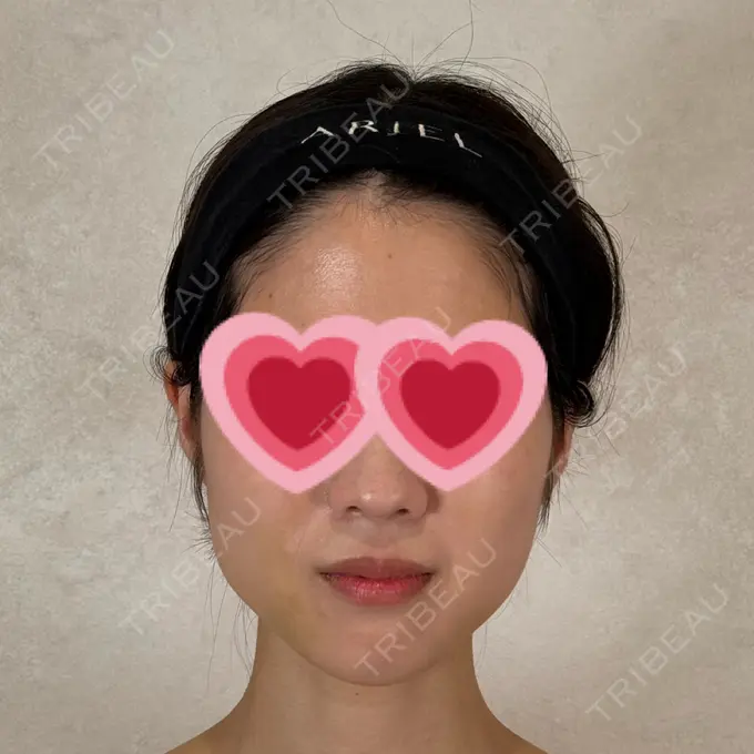 糸リフト / ボトックス（エラ・小顔） アリエル美容クリニック 横浜院 DAY 10 メイン用