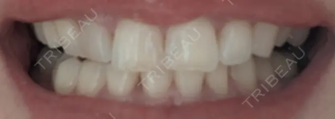 ホワイトニング SK新宿歌舞伎町美容外科・歯科 AFTER メイン用