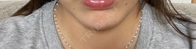 ボトックス（あご） / ヒアルロン酸注入（あご） HAAB×DREAM BEAUTY CLINIC 大阪梅田院 DAY 1 メイン用