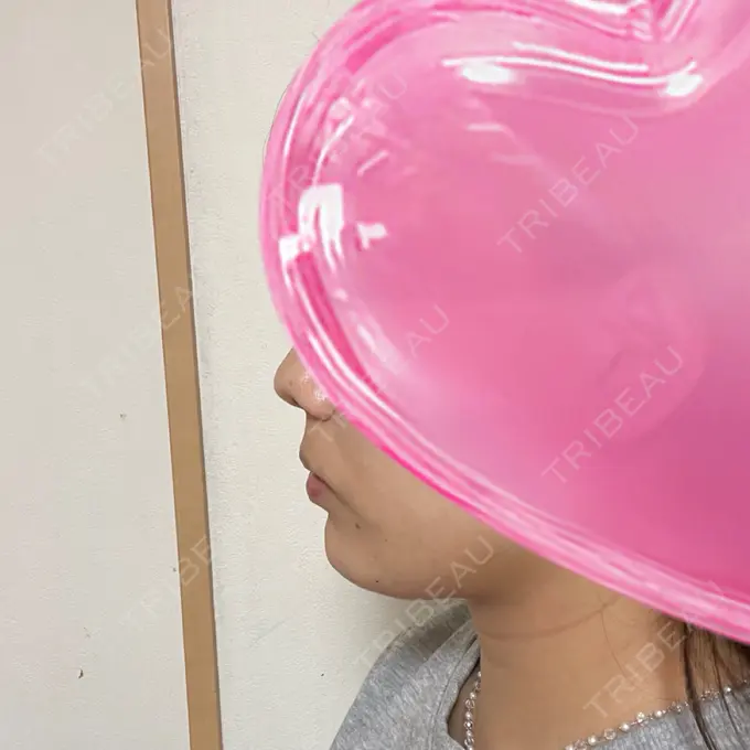 ボトックス（あご） / ヒアルロン酸注入（あご） HAAB×DREAM BEAUTY CLINIC 大阪梅田院 DAY 1 メイン用