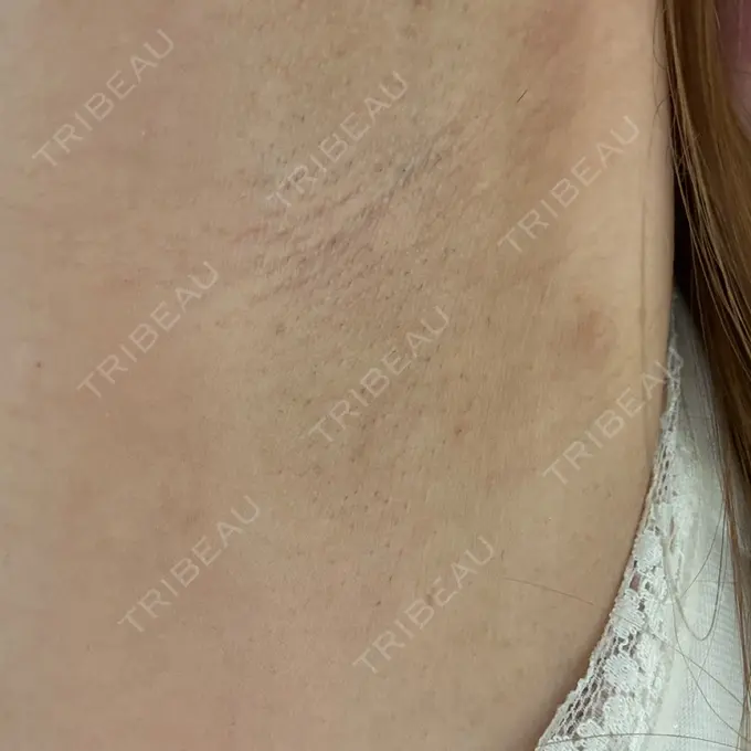 医療脱毛（ワキ） ルラ美容クリニック 神戸院 DAY 0 メイン用