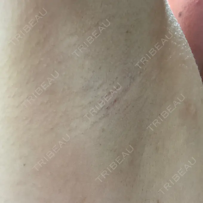 医療脱毛（ワキ） ルラ美容クリニック 神戸院 DAY 11 メイン用