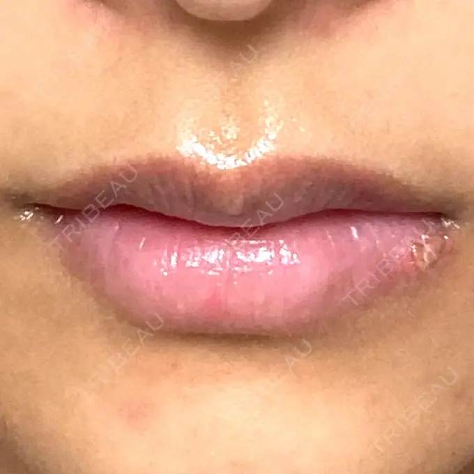 アートメイク（眉） / アートメイク（唇） Tokyo Tensei Clinic 新宿院 DAY 4 メイン用