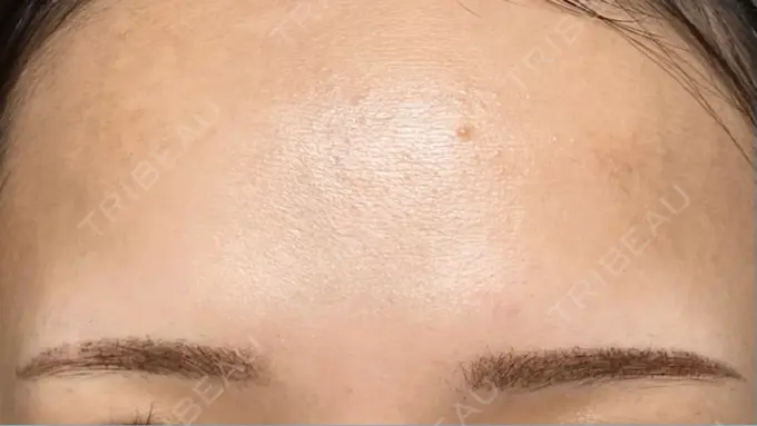 アートメイク（眉） / アートメイク（唇） Tokyo Tensei Clinic 新宿院 DAY 4 メイン用