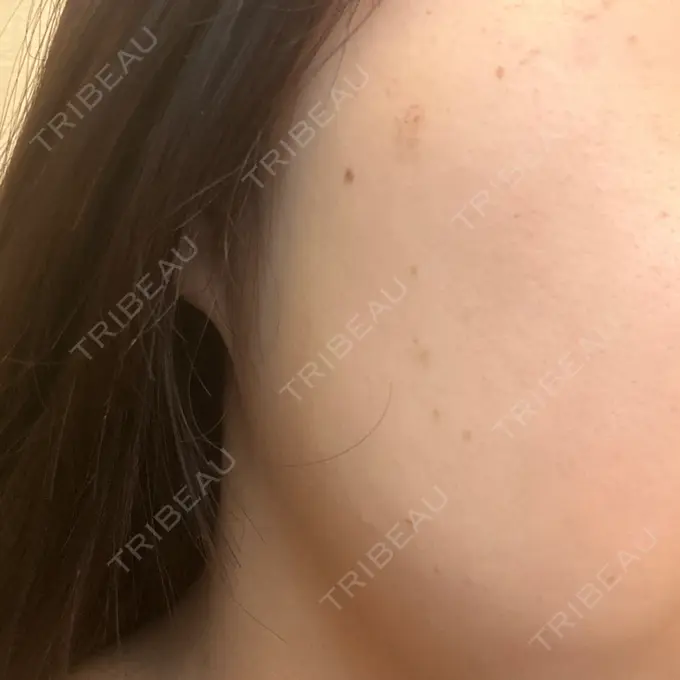 ピーリング（ハリ・ツヤ） / ルメッカ BITO BEAUTY CLINIC DAY 2 メイン用