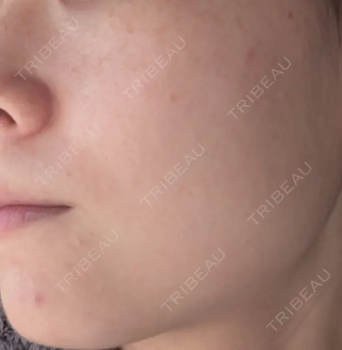 ルメッカ 大美会クリニック 神戸院 AFTER メイン用