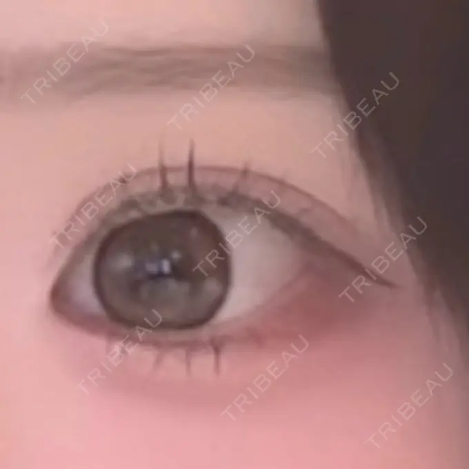 二重埋没 / ヒアルロン酸注入（涙袋） / ヒアルロン酸注入（唇） / その他（口元） 恵聖会クリニック 京橋院 DAY 5 メイン用