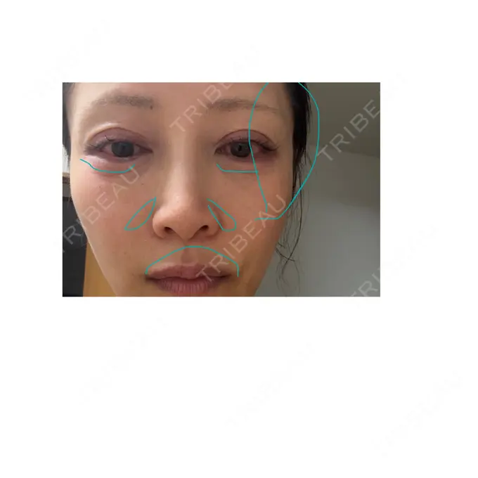 ヒアルロン酸注入（涙袋） / ヒアルロン酸注入（唇） / ヒアルロン酸溶解 / ヒアルロン酸注入（こめかみ） / ヒアルロン酸注入（鼻翼基部） EOL CLINIC【オルクリニック】 DAY 1 メイン用