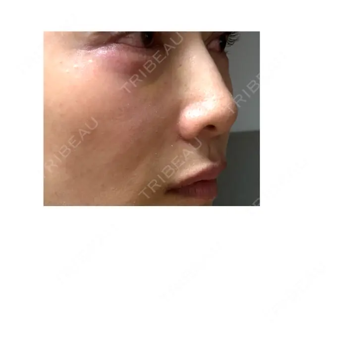 ヒアルロン酸注入（涙袋） / ヒアルロン酸注入（唇） / ヒアルロン酸溶解 / ヒアルロン酸注入（こめかみ） / ヒアルロン酸注入（鼻翼基部） EOL CLINIC【オルクリニック】 DAY 1 メイン用