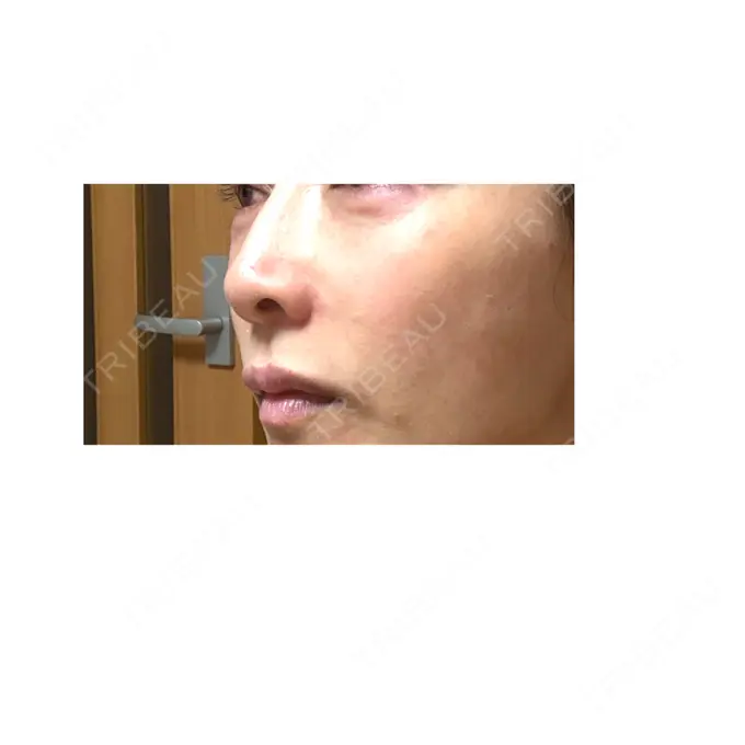 ヒアルロン酸注入（涙袋） / ヒアルロン酸注入（唇） / ヒアルロン酸溶解 / ヒアルロン酸注入（こめかみ） / ヒアルロン酸注入（鼻翼基部） EOL CLINIC【オルクリニック】 DAY 1 メイン用