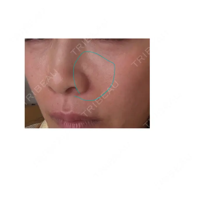 ヒアルロン酸注入（涙袋） / ヒアルロン酸注入（唇） / ヒアルロン酸溶解 / ヒアルロン酸注入（こめかみ） / ヒアルロン酸注入（鼻翼基部） EOL CLINIC【オルクリニック】 DAY 9 メイン用