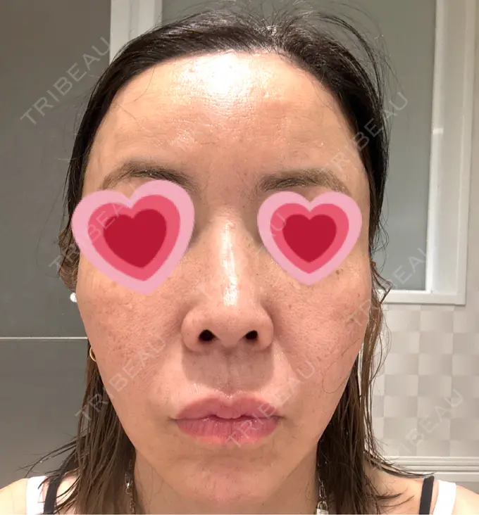 ポテンツァ ルラ美容クリニック 大宮院 / ルラスキンクリニック 大宮院 AFTER メイン用