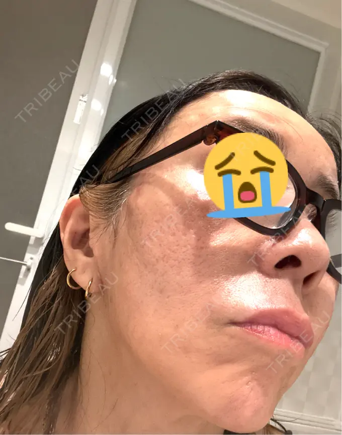 ポテンツァ ルラ美容クリニック 大宮院 / ルラスキンクリニック 大宮院 DAY 4 メイン用