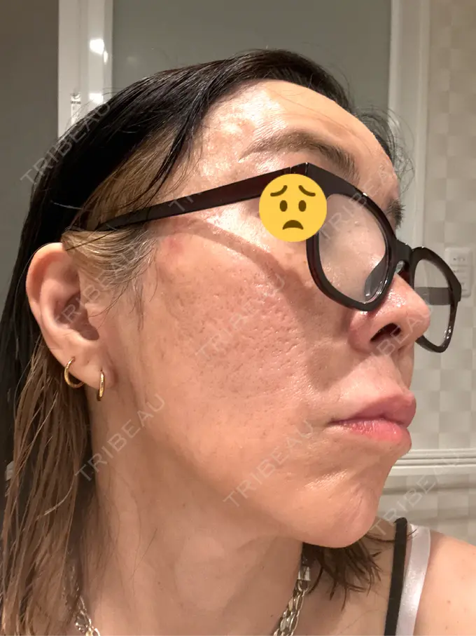 ポテンツァ ルラ美容クリニック 大宮院 / ルラスキンクリニック 大宮院 DAY 4 メイン用