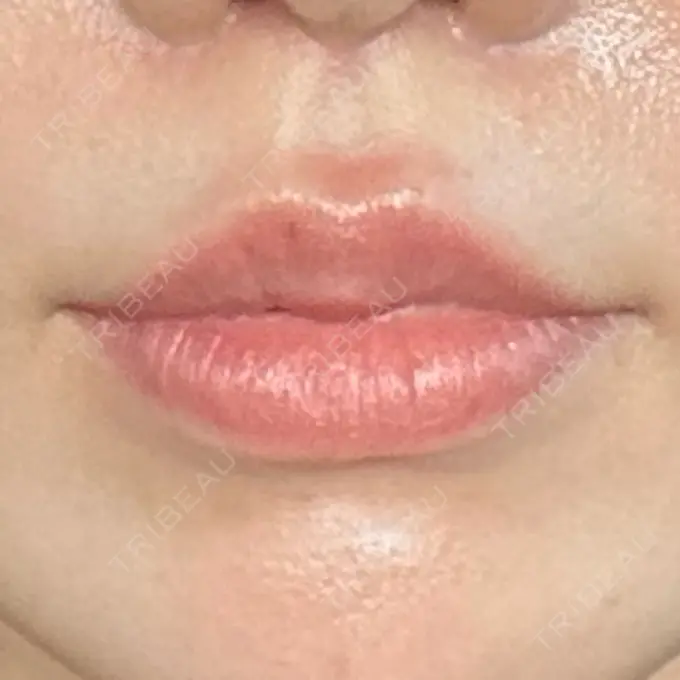 人中短縮 eクリニック 大阪梅田 西日本統括院 DAY 78 メイン用