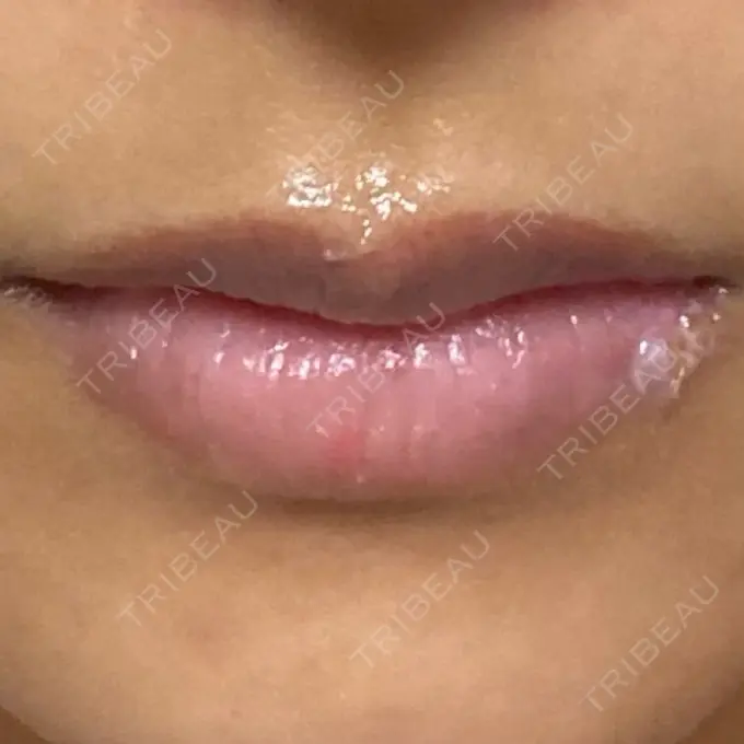 アートメイク（眉） / アートメイク（唇） Tokyo Tensei Clinic 新宿院 DAY 5 メイン用