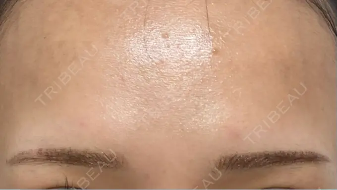 アートメイク（眉） / アートメイク（唇） Tokyo Tensei Clinic 新宿院 DAY 5 メイン用