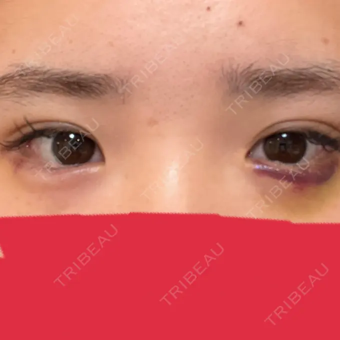 ヒアルロン酸注入（涙袋） アネシス美容クリニック AFTER メイン用