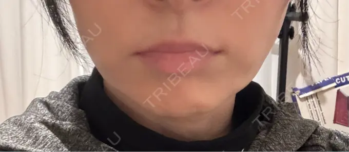 ヒアルロン酸注入（鼻翼基部） ルラ美容クリニック 渋谷本院 DAY 5 メイン用